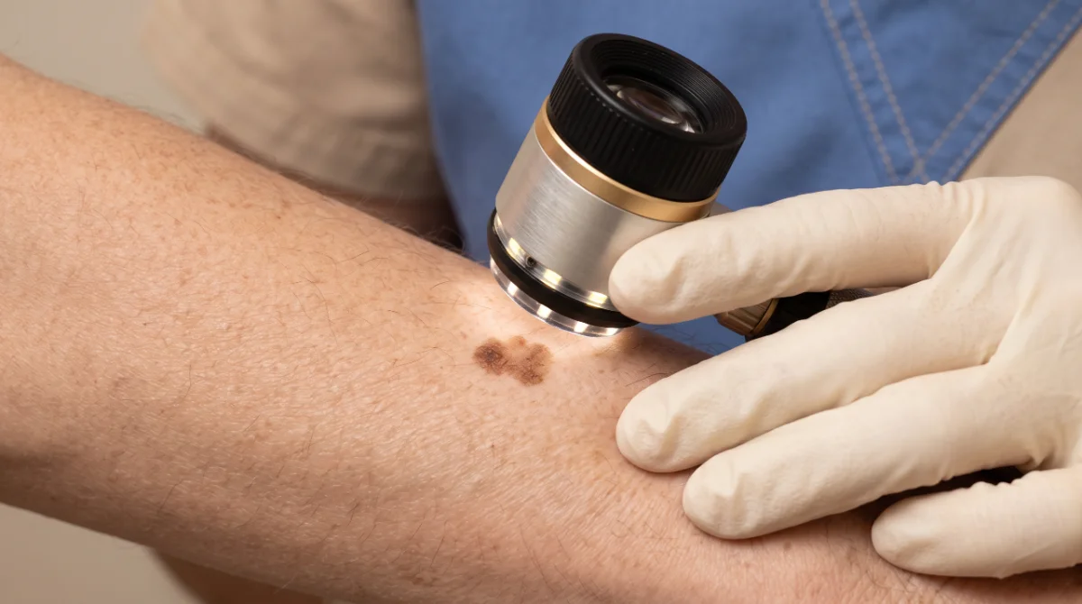 Nahaufnahme einer Hautveränderung bei der dermatoskopischen Untersuchung